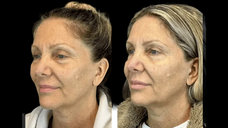Ultimate Guide to Choosing the Best Aesthetic Clinic in Dubai for Your Skin Type