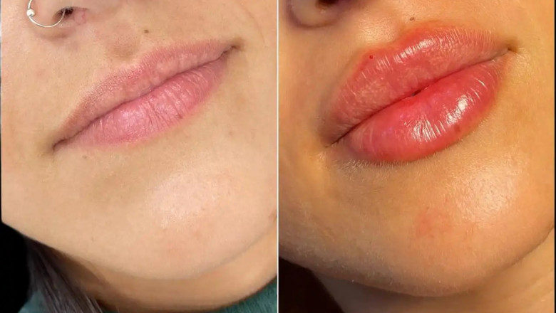 Are Russian Lip Fillers in Dubai Right for You? Here’s What to Consider