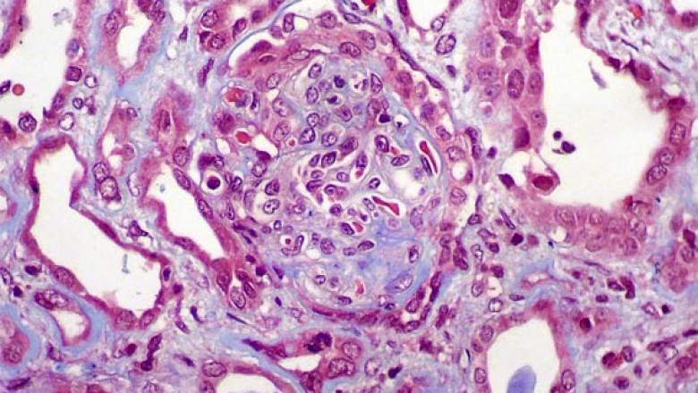 NephCure Inc.: Identifying Infantile Nephrotic Syndrome Symptoms and Understanding IgA Nephropathy Causes
