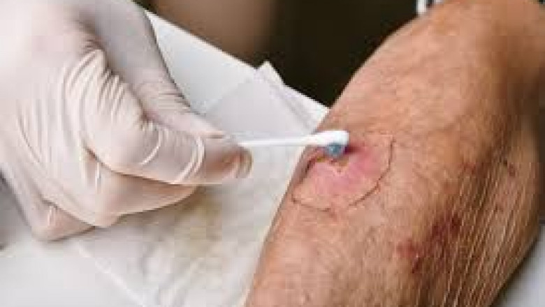 Next-Generation Wound Care Technologies: Market Evolution from 2025 to 2035