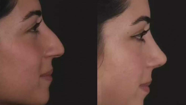 Nose Deviated Septum Surgery in Dubai: A Step-by-Step Guide