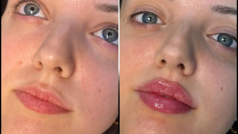 The Cost of Fillers Treatments in Dubai: Is It Worth the Investment?