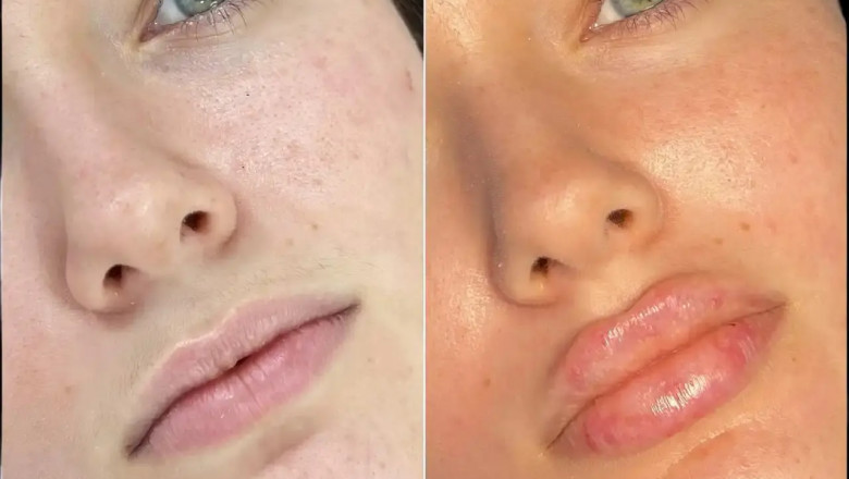 The Rise of Fillers Treatments in Dubai’s Beauty Scene
