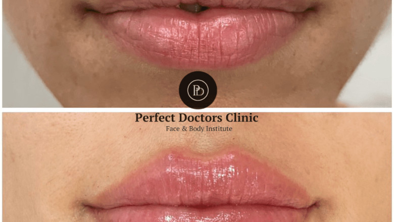 The Best Doctors in dubai on Juvederm Treatment Risks and Benefits