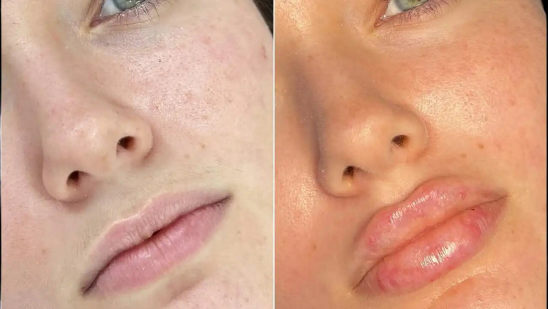 The Advantages of Choosing Fillers in Dubai Over Surgery