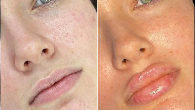 Best Plastic Surgeon in Dubai for Fillers: Perfecting Natural Looks