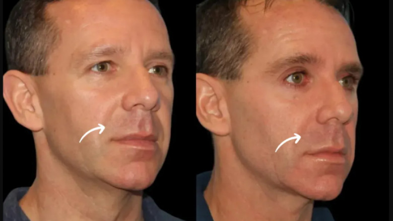 The Role of Technology in Sculptra Fillers with the Best Plastic Surgeon in Dubai