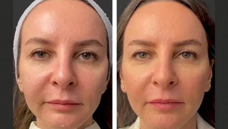 Top Benefits of Mesotherapy Treatments in Dubai