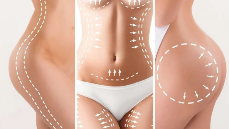 Mommy Makeover in Dubai: The Role of Liposuction and Tummy Tucks in a Mommy Makeover