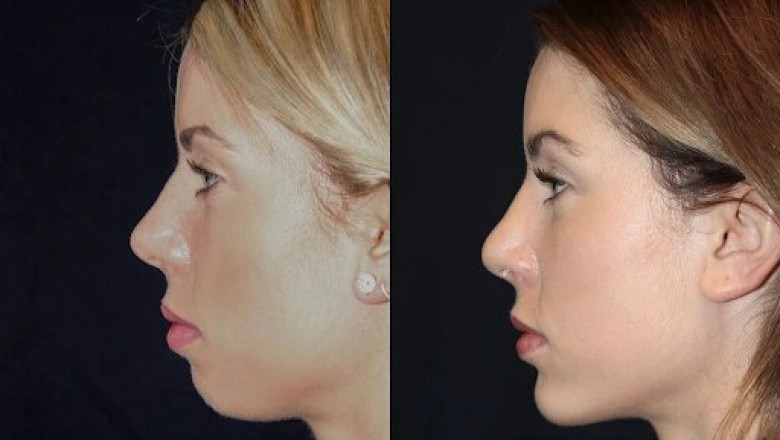 Best Doctors in dubai Reveal How Chin Fillers Can Transform Your Profile
