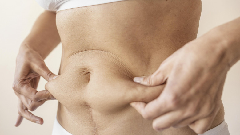 Best Liposuction Doctors in Dubai Share Their Secrets to Success