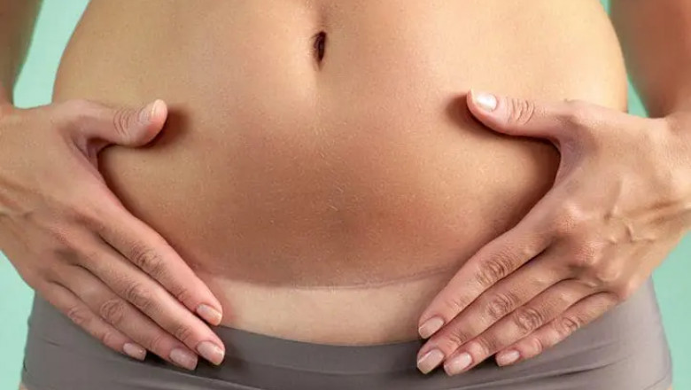 Mommy Makeover in Dubai: The Recovery Process and What to Expect After a Mommy Makeover