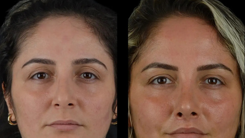 How the Best Plastic Surgeons in Dubai Offer Natural Results with Cheek Fillers