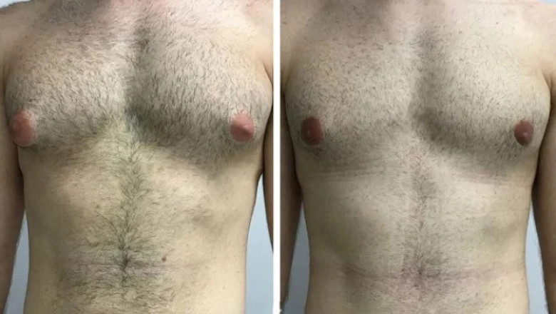 Risks and Complications of Gynecomastia Surgery in Dubai – What You Should Know