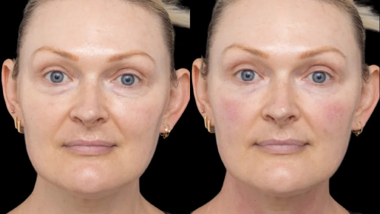 Safety and Quality Assurance from the Best Plastic Surgeons in Dubai for Under Eye Fillers