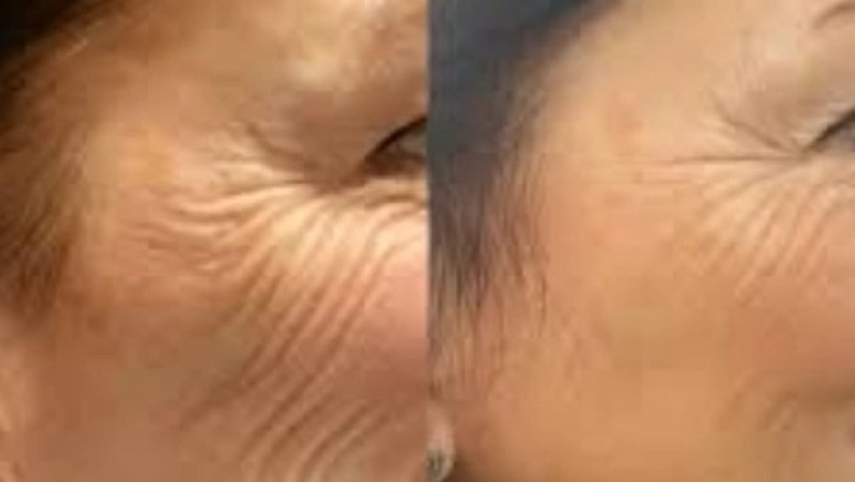 Anchor Confidence with the Best Plastic Surgeon in dubai and Profhilo