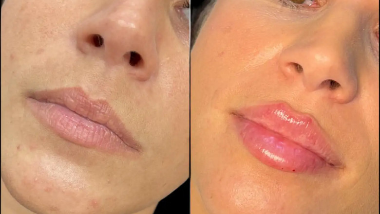 Why Clients Choose the Best Plastic Surgeon in Dubai for Fillers