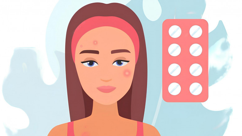 Hormonal Acne Explained: Causes, Triggers, and Treatments