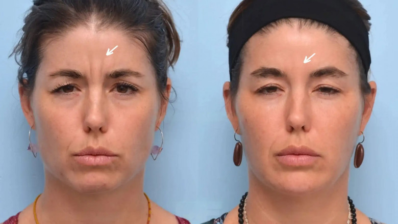 Best Aesthetic Clinic in Dubai: What to Expect from Your First Botox Session