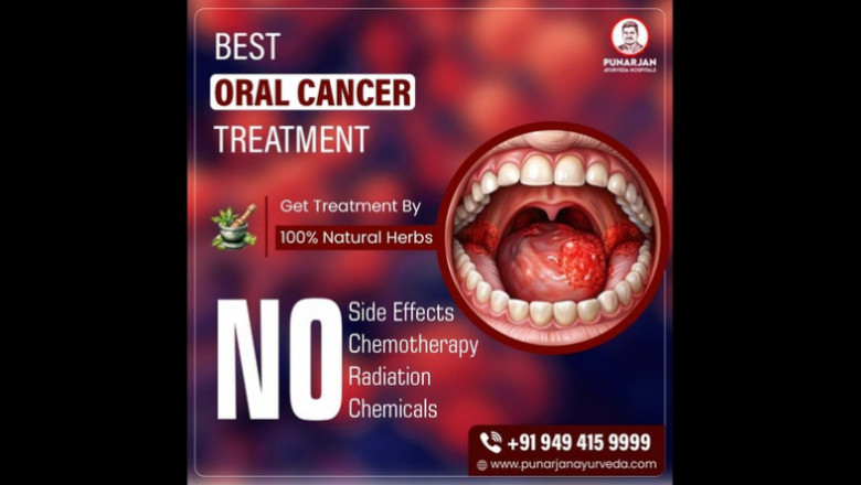Best Oral Cancer Treatment Hospitals in Chennai