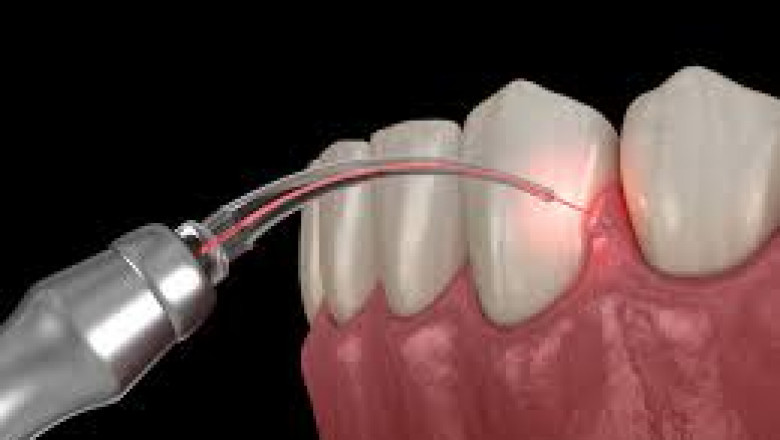Dental Lasers Market Future Trends Reshaping Global Dental Practices