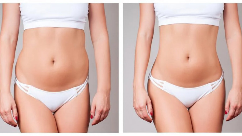 Is Fat Transfer Surgery in Dubai Safe? Expert Insights and Patient Experiences