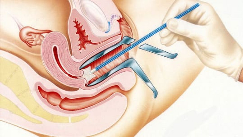 How Pap Smears Help in Detecting HPV in Dubai: What You Need to Know