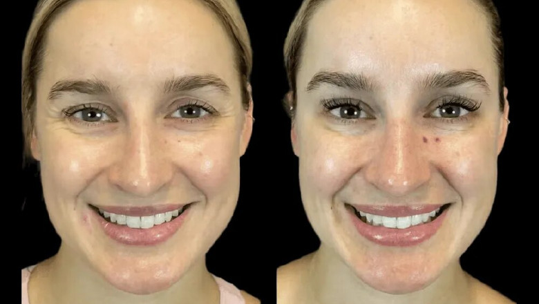 How the Best Aesthetic Clinics in dubai Customize Botox for Different Skin Types
