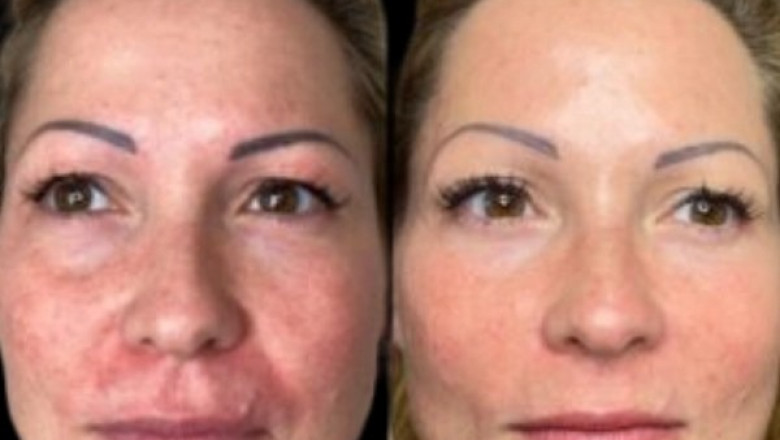 Discover Profhilo Experts Among Best Plastic Surgeons in dubai