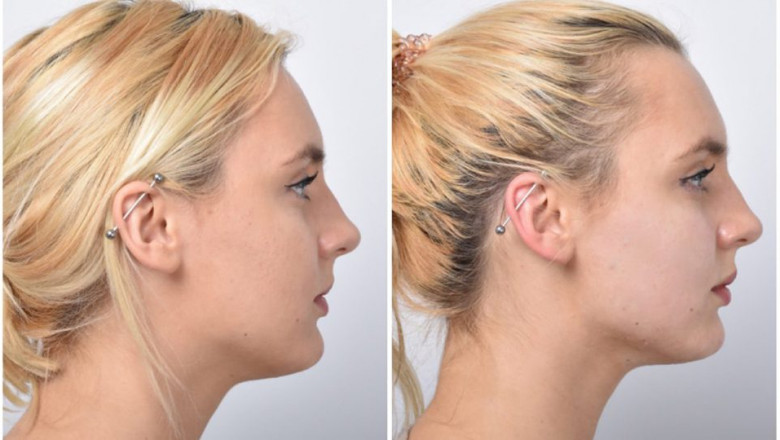 Facial Thread Lift in Dubai: How to Maintain Results After a Facial Thread Lift