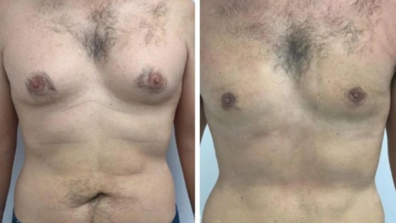 How to Choose the Best Gynecomastia Surgeons in dubai with a Proven Track Record