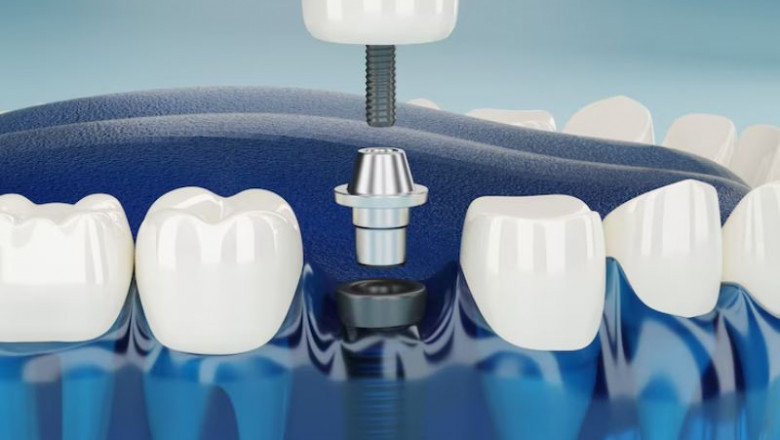 Best Dental Implants in Gurgaon | Expert Care by Dr. Shevta at Artistree Dental