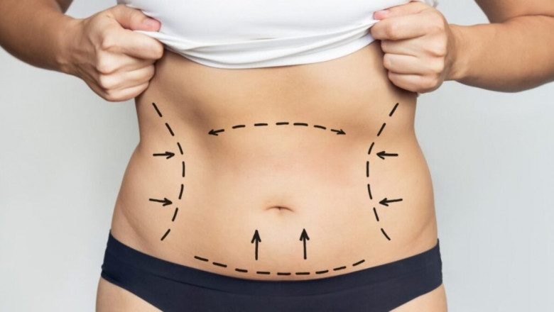 Best Liposuction Doctors in Dubai Redefine Body Contouring