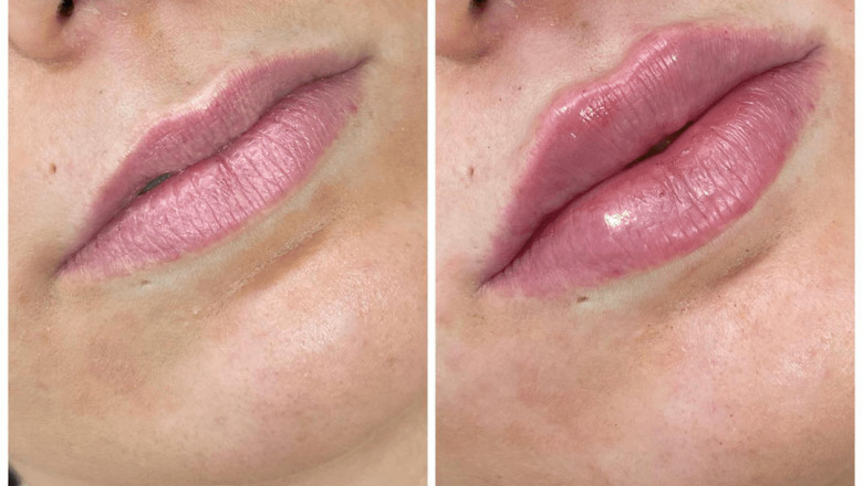 Best Plastic Surgeon in Dubai: Dermal Fillers for Cheek Enhancement