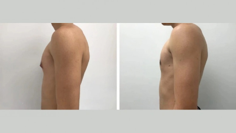 Gynecomastia vs Fat: How to Tell the Difference and What to Do in Dubai