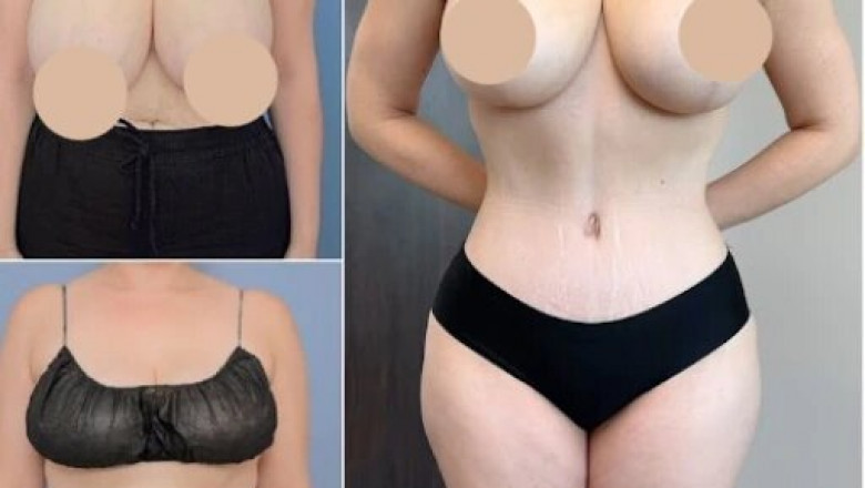 How Tummy Tuck in Dubai Can Transform Your Confidence and Appearance