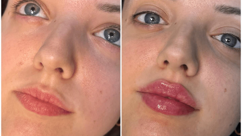 Juvederm for Facial Sculpting: A Guide from the Best Plastic Surgeon in Dubai