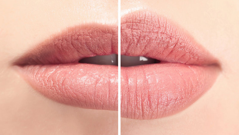 Plump, Smooth, and Confident—Lip Aesthetics in Calgary