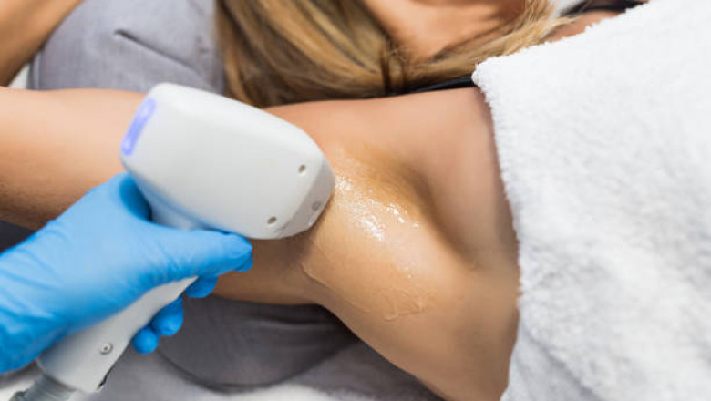 The Ultimate Guide to Laser Hair Removal in Toronto
