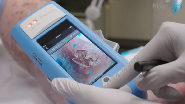Digital Wound Measurement Devices Market Estimated to Grow Owing to AI Imaging