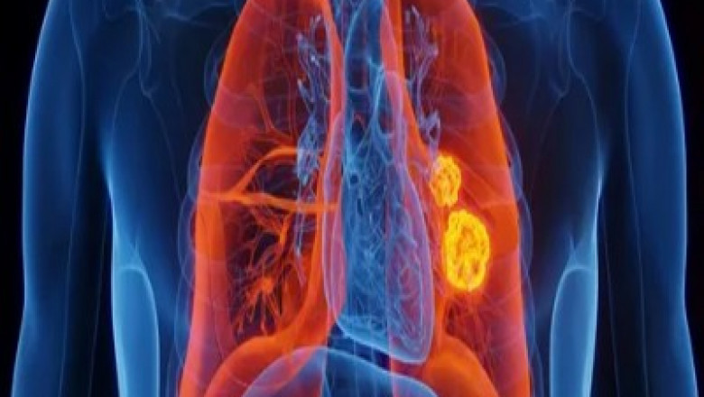 Advancements in ALK-Positive Lung Cancer Treatment: Targeted Therapies and Precision Medicine