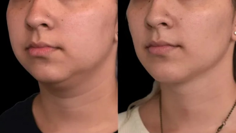 Are There Age Limits for Double chin removal in Dubai?