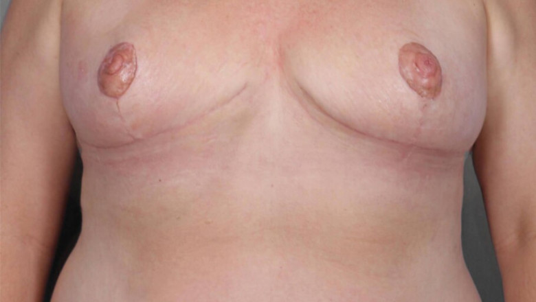 Understanding SWIM Breast Reconstruction: A Comprehensive Guide for Women