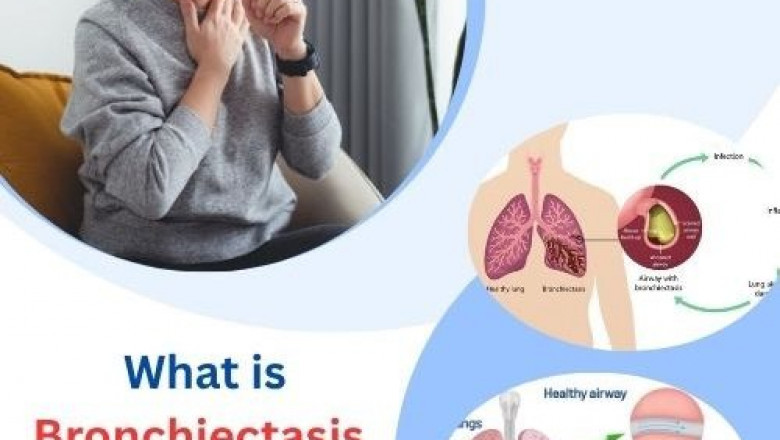 What is Bronchiectasis, and How is It Treated?