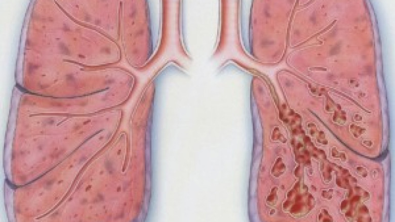 Bronchiectasis Relief can be found in Natural Treatment