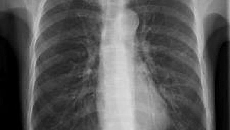 New ways to handle Bronchiectasis!