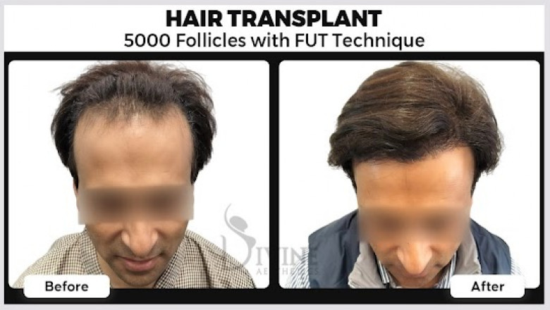 Transform Your Look: The Ultimate 2025 Guide to Hair Transplant in Gurgaon & Lucknow by Dr. Amit Gupta