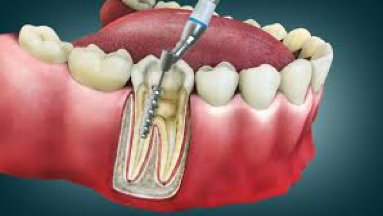 Advanced Root Canal Treatment in Ahmedabad – New Smile Clinic