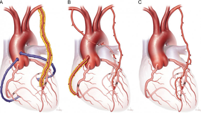 Coronary Artery Bypass Grafting Market Soars on Rising Heart Disease