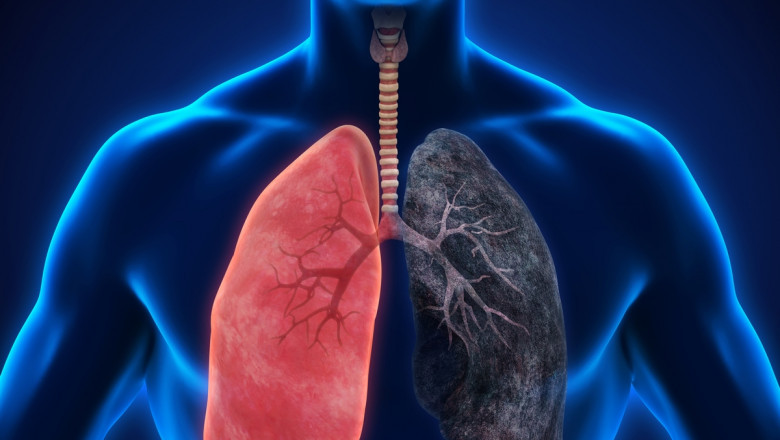 Global Chronic Obstructive Pulmonary Disease (COPD) Diagnosis Market